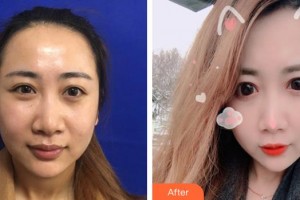 邯鄲京美整形醫(yī)院安在勛整形價(jià)格表附埋線提升案例展示