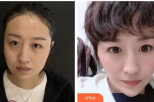 邯鄲都市整形美容醫(yī)院李秀蘭整形價(jià)格表附埋線提升案例展示