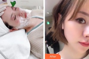 邢臺手外科醫(yī)院整形美容科高健整形價(jià)格表附埋線提升案例展示