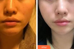 邢臺人民醫(yī)院醫(yī)學(xué)美容科李麗莎住院醫(yī)師整形價(jià)格表附埋線提升案例展示