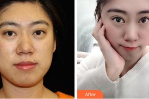 邢臺美在人生（原美聯(lián)臣）醫(yī)療美容診所王桂華整形價(jià)格表附埋線提升案例展示