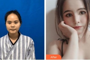 邢臺美在人生（原美聯(lián)臣）醫(yī)療美容診所劉洪達整形價格表附射頻緊膚案例展示