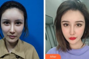 邢臺美琳達醫(yī)療美容診所賈龍飛整形價格表附熱瑪吉案例展示