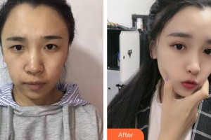 邢臺(tái)尚美醫(yī)療美容醫(yī)院劉輝整形價(jià)格表附埋線提升案例展示