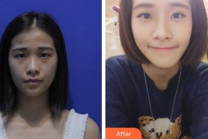 邢臺(tái)伊美醫(yī)療美容診所李學(xué)英整形價(jià)格表附眼部綜合案例展示