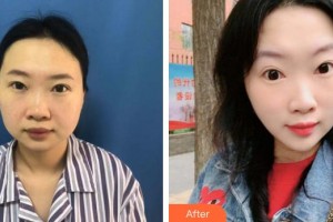 邢臺(tái)王桂華醫(yī)療美容診所王桂華整形價(jià)格表附切開雙眼皮案例展示