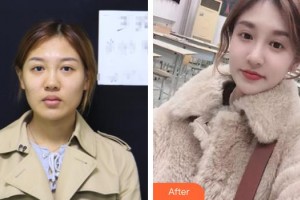 保定珍潤(rùn)醫(yī)療美容門診部何棟良整形價(jià)格表附肋軟骨隆鼻案例展示