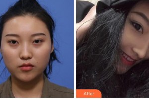 保定世紀(jì)協(xié)和醫(yī)院整形美容中心曹經(jīng)棟整形價格表附肋軟骨隆鼻案例展示