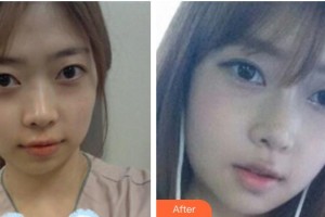 保定藍(lán)山醫(yī)療美容醫(yī)院杜建龍整形價格表附假體隆鼻案例展示