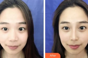 保定藍(lán)山醫(yī)療美容醫(yī)院劉海濤整形價格表附鼻部綜合案例展示