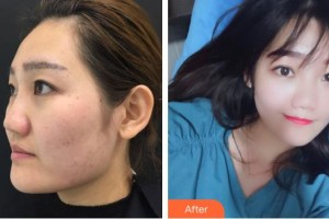 保定世紀(jì)協(xié)和醫(yī)院整形美容中心楊德發(fā)整形價格表附熱拉提案例展示