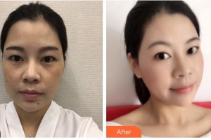 保定珍潤醫(yī)療美容門診部肖蕾整形價格表附眼部綜合案例展示