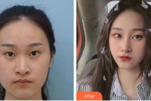 保定珍潤醫(yī)療美容門診部戚容整形價格表附切開雙眼皮案例展示