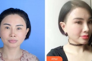 保定珍潤醫(yī)療美容門診部王飛整形價(jià)格表附眼部綜合案例展示