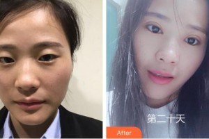 保定新視眼科醫(yī)院熊寧整形價格表附切開雙眼皮案例展示