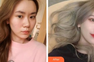 保定新視眼科醫(yī)院王鳳翔整形價格表附定點(diǎn)雙眼皮案例展示