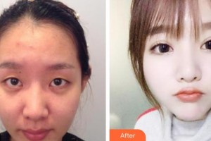 保定新視眼科醫(yī)院劉富奎整形價格表附眼部綜合案例展示