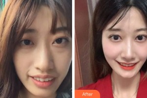 中山美南華整形美容醫(yī)院楊達勇整形價格表附牙齒矯正案例展示