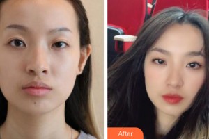 中山大學(xué)附屬第三醫(yī)院整形美容中心白莉整形價格表附植發(fā)案例展示