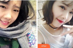 保定新視眼科醫(yī)院申文輝整形價格表附切開雙眼皮案例展示