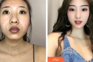 保定藍(lán)山醫(yī)療美容醫(yī)院張揚(yáng)整形價(jià)格表附埋線提升案例展示