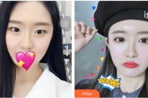 保定悅美醫(yī)療美容門診部孟令申整形價格表附切開雙眼皮案例展示