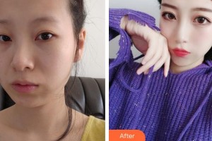 保定藍(lán)山醫(yī)療美容醫(yī)院張素芬整形價(jià)格表附埋線提升案例展示