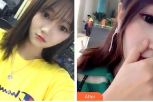 保定東陽口腔醫(yī)院白小青整形價(jià)格表附超聲波潔牙案例展示