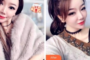 保定東陽口腔醫(yī)院趙晨整形價(jià)格表附牙齒隱形矯正案例展示