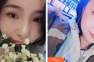 保定東陽口腔醫(yī)院王增光整形價(jià)格表附牙齒隱形矯正案例展示