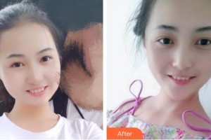 張家口維多利亞醫(yī)療美容醫(yī)院張凱整形價(jià)格表附耳軟骨復(fù)合隆鼻案例展示