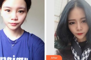 張家口維多利亞醫(yī)療美容醫(yī)院王亞勇整形價(jià)格表附鼻部綜合案例展示