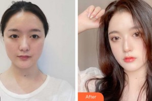 哈爾濱禾力康醫(yī)療美容醫(yī)院金尚訓(xùn)整形價格表附眼部手術(shù)案例展示