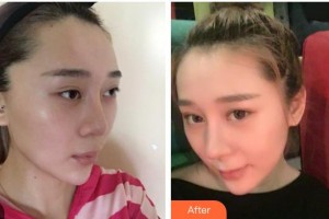 張家口維多利亞醫(yī)療美容醫(yī)院李成輝整形價(jià)格表附鼻部綜合案例展示