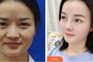 張家口維多利亞醫(yī)療美容醫(yī)院譚亞君整形價(jià)格表附鼻部綜合案例展示