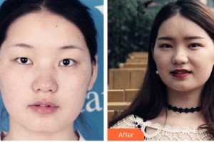 承德醫(yī)學(xué)院附屬醫(yī)院燒傷整形科孫奎整形價(jià)格表附定點(diǎn)雙眼皮案例展示
