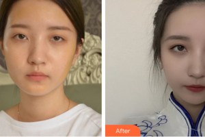 哈爾濱美聯(lián)致美整形醫(yī)院潘寶華整形價格表附自體脂肪填充案例展示