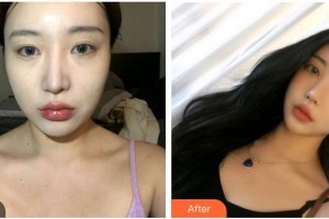 承德愛(ài)爾眼科醫(yī)院劉毅坤整形價(jià)格表附內(nèi)切祛眼袋案例展示