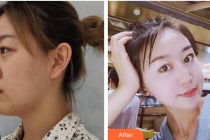 承德愛(ài)爾眼科醫(yī)院韓占南整形價(jià)格表附眼部綜合案例展示