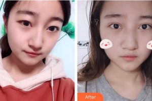 承德愛(ài)爾眼科醫(yī)院蘇暢整形價(jià)格表附眼部綜合案例展示