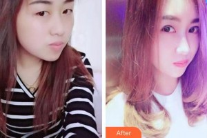 承德朝聚眼科醫(yī)院張鐵民整形價(jià)格表附切開(kāi)雙眼皮案例展示