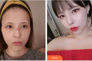 承德美天醫(yī)療美容醫(yī)院王雪艷整形價(jià)格表附眼部綜合案例展示