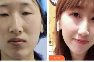 承德朝聚眼科醫(yī)院楊亞軍整形價(jià)格表附切開(kāi)雙眼皮案例展示