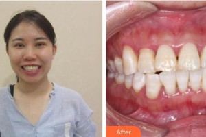 承德愛(ài)爾眼科醫(yī)院王明月整形價(jià)格表附牙齒隱形矯正案例展示