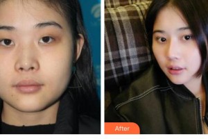 滄州奧拉克醫(yī)療美容醫(yī)院車景龍整形價(jià)格表附鼻部綜合案例展示