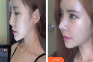 滄州楓華醫(yī)療美容診所肖麗芳整形價(jià)格表附鼻部綜合案例展示