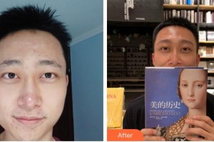 滄州華美醫(yī)療美容醫(yī)院宋石磊整形價(jià)格表附植發(fā)案例展示