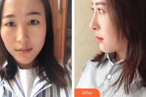 滄州京美醫(yī)療美容診所提曉華整形價(jià)格表附鼻部綜合案例展示