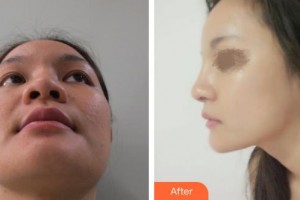 滄州靜港醫(yī)療美容診所羅忠振整形價(jià)格表附鼻部綜合案例展示