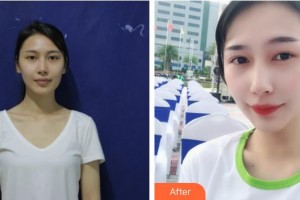 滄州眼科醫(yī)院王彥整形價(jià)格表附眼部綜合案例展示